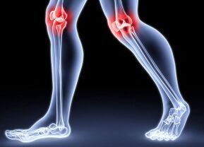 Những lý do cho sự phát triển của bệnh viêm khớp gối