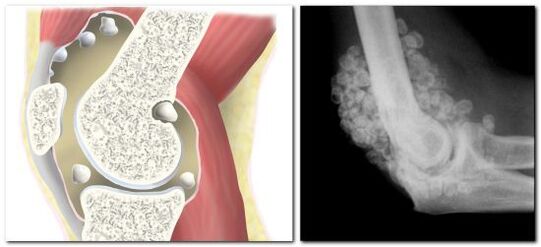 bệnh chondromatosis với đau ở khớp hông